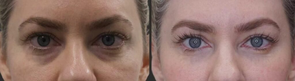 antes e depois de preenchimento de olheiras​1