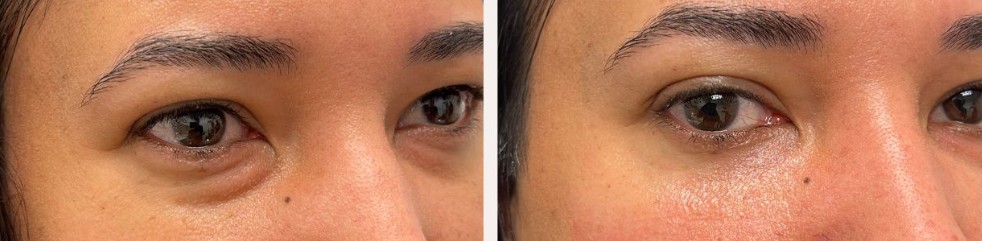 antes e depois de preenchimento de olheiras​2