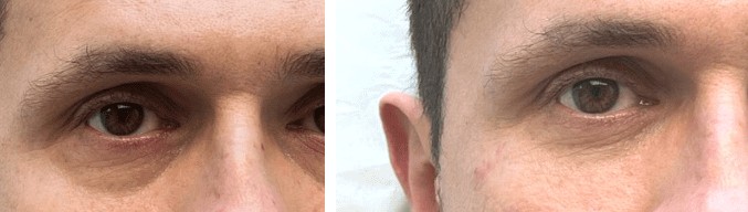 antes e depois de preenchimento de olheiras​4