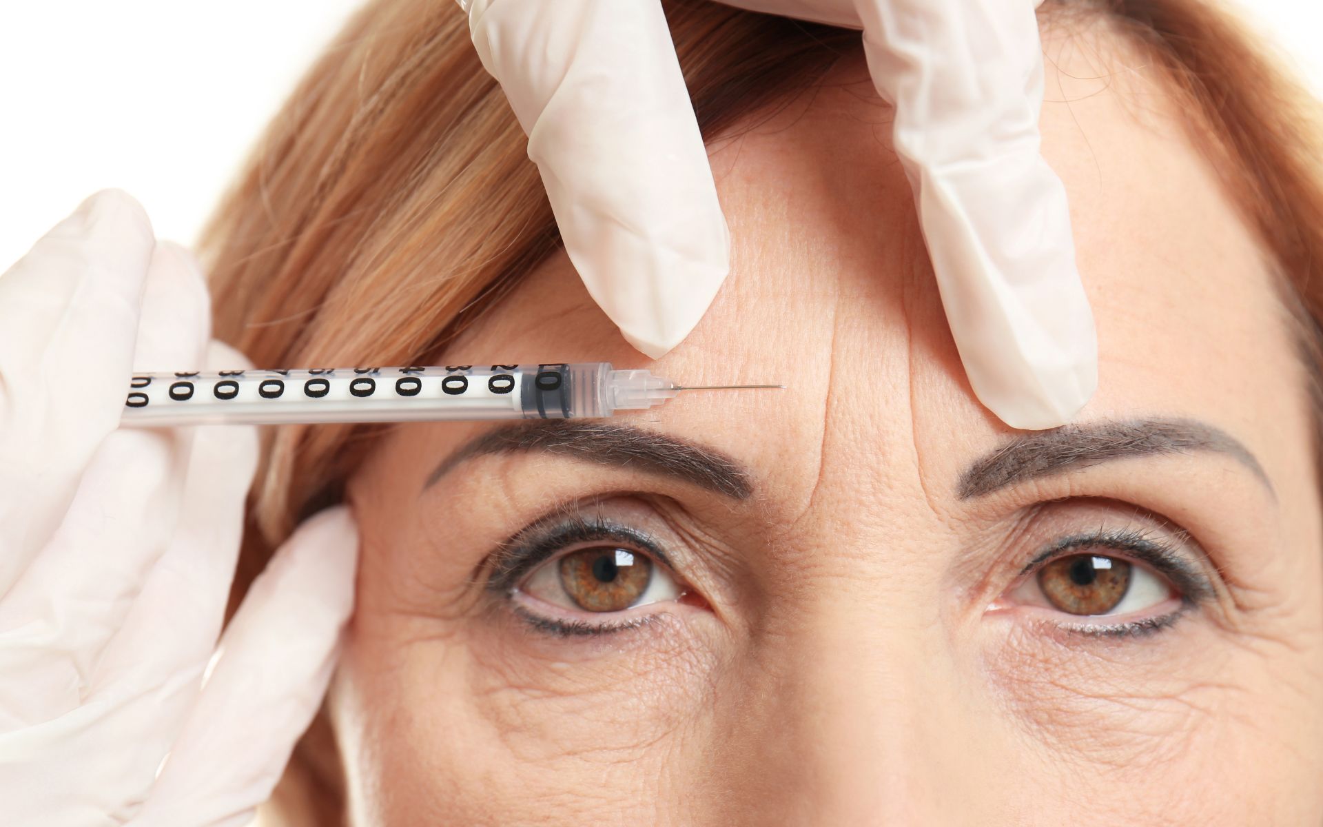 botox no rosto quanto tempo para fazer efeito​